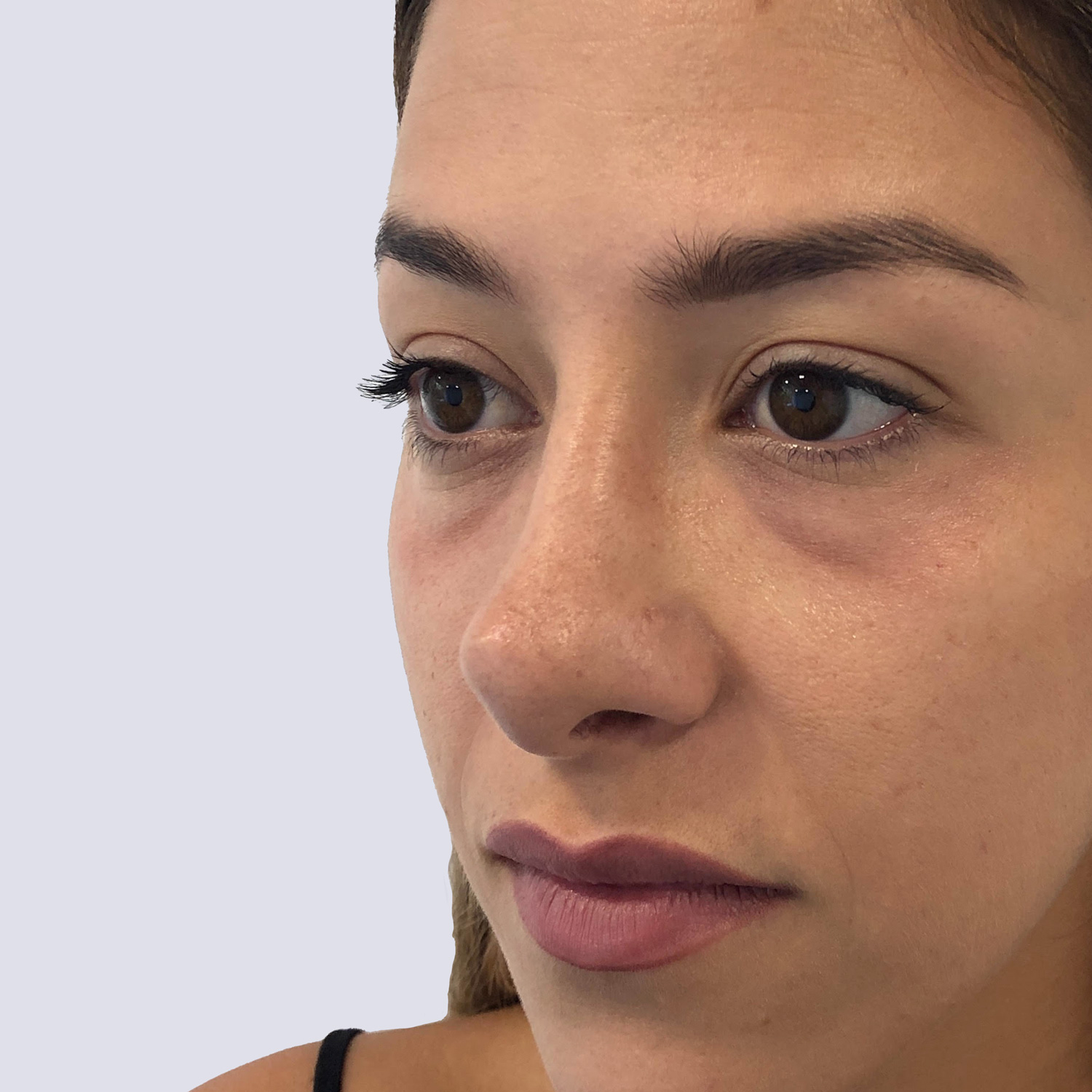 Clínica Vieira - Tratamientos faciales para corregir las ojeras