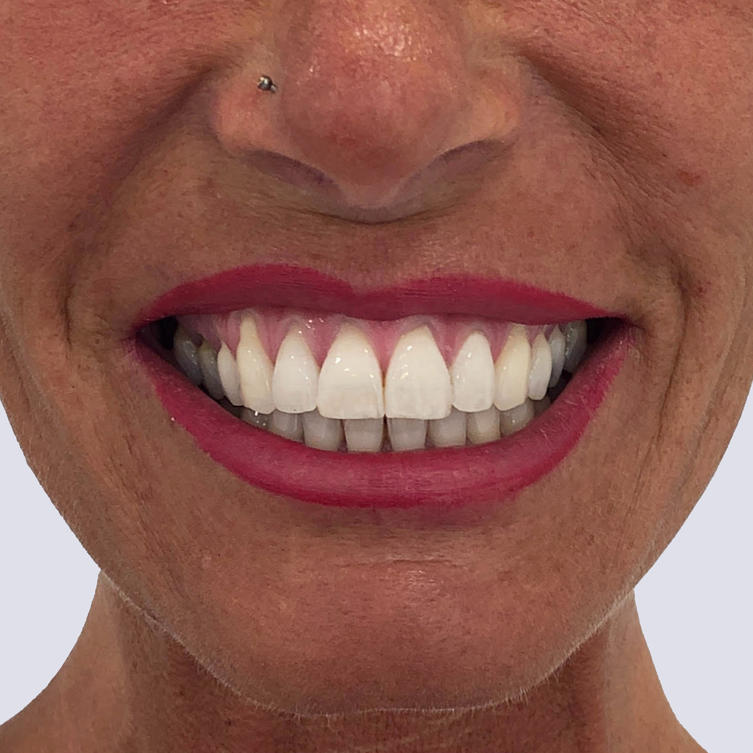 Resultados de tratamiento sonrisa gingival