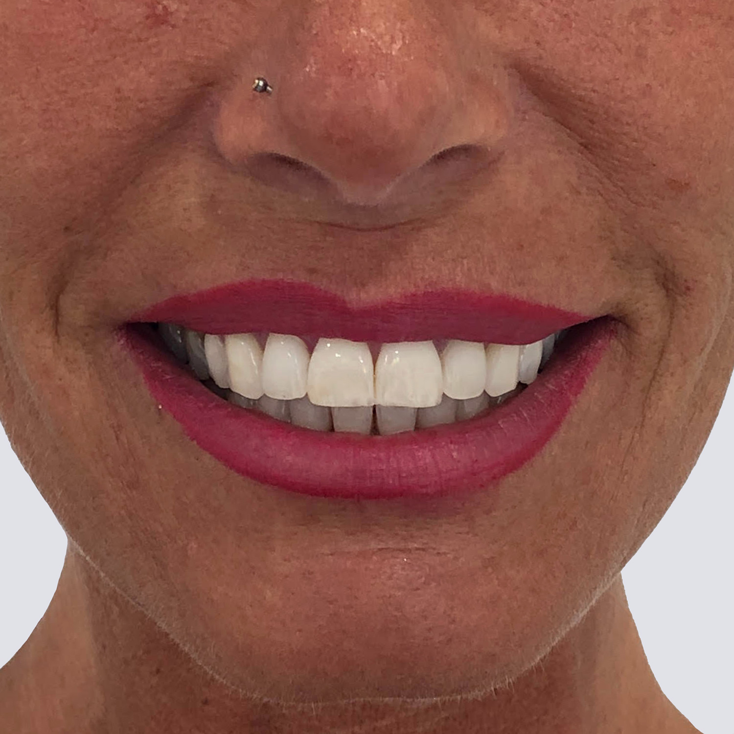 Resultados de tratamiento sonrisa gingival